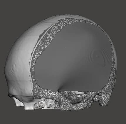 Corte del modelo 3D que muestra la cara interna de la placa y su contacto con el borde óseo