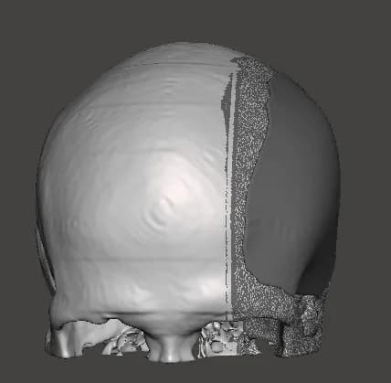 Render del cráneo con la extensión del defecto cubierta por la placa a medida