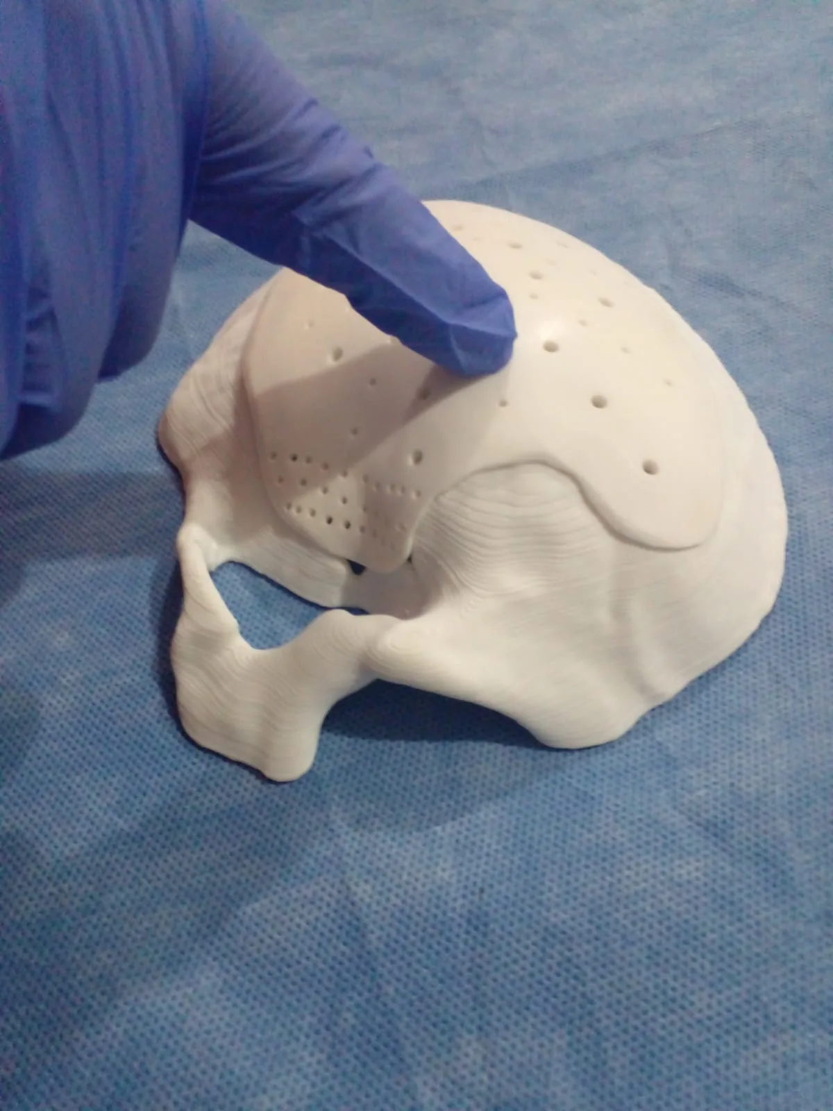 Placa craneal a medida verificada sobre el modelo 3D impreso del cráneo