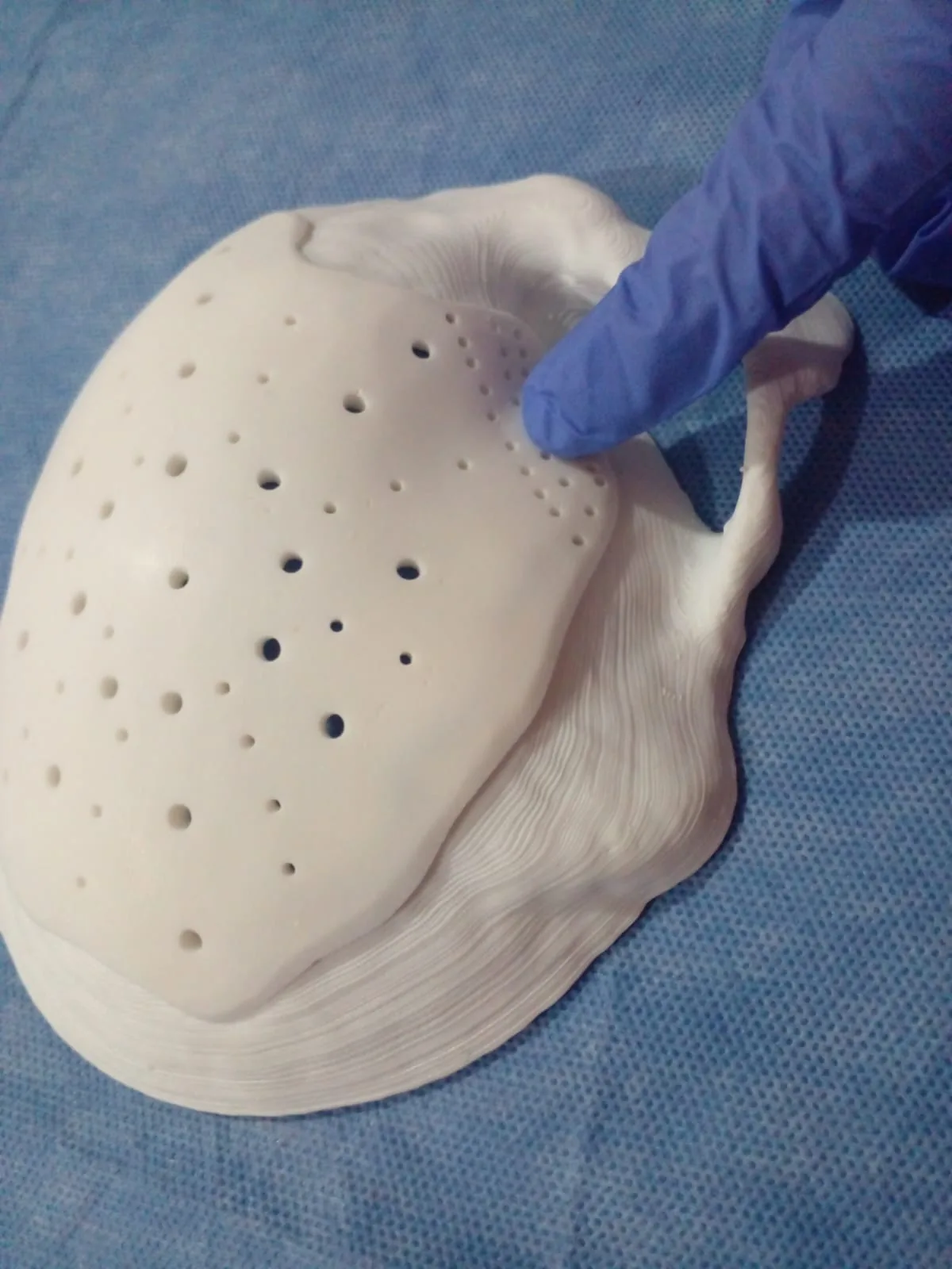 Placa craneal a medida con perforaciones, apoyada sobre el modelo 3D del cráneo