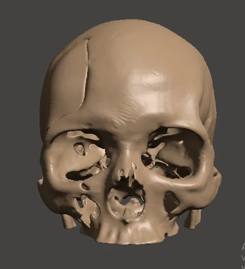 Render frontal del cráneo con la placa craneal a medida