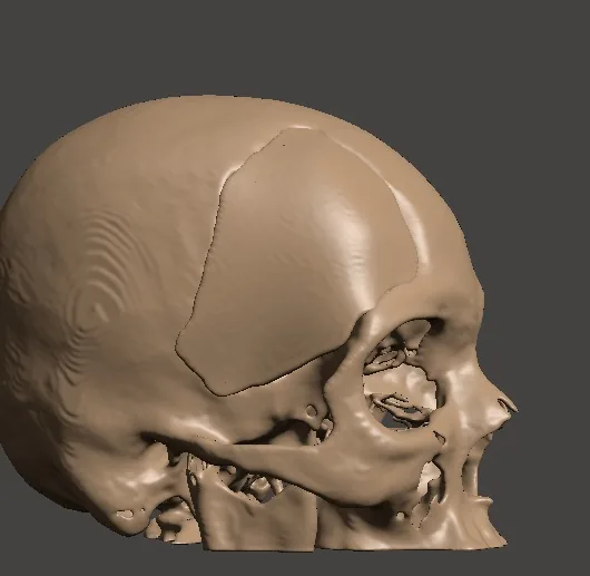 Render lateral del cráneo con la placa craneal a medida integrada al contorno