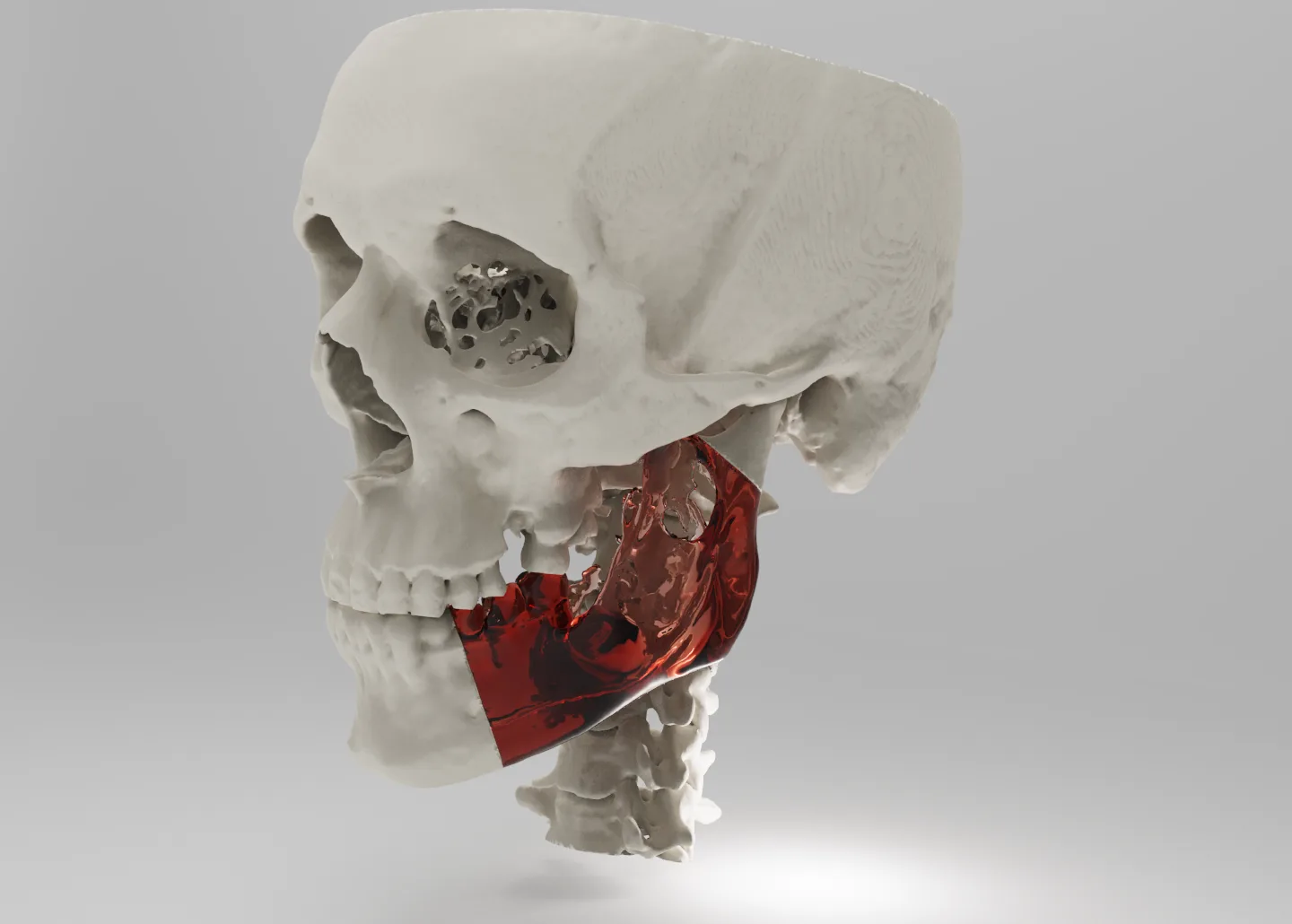 Reconstrucción mandibular a medida montada sobre el modelo 3D del cráneo del caso